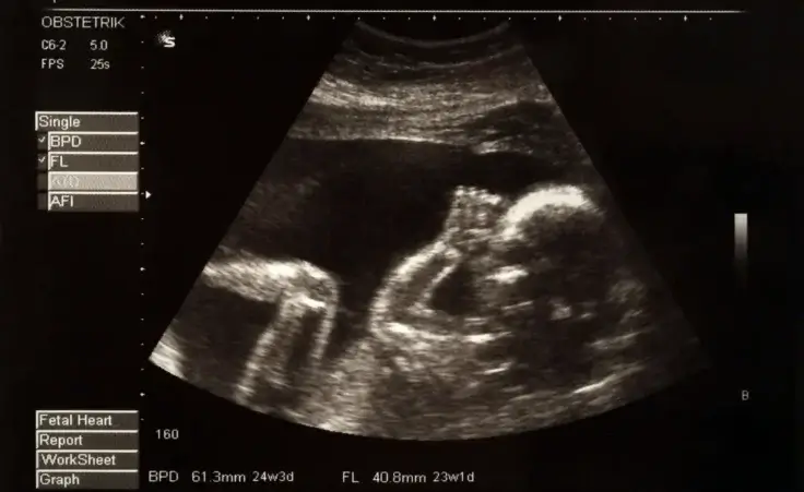 Ultrasound picture of a baby in utero. By Mikael Damkier/stock.adobe.com